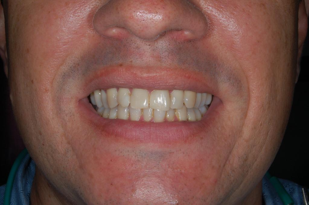 Antes Antes
