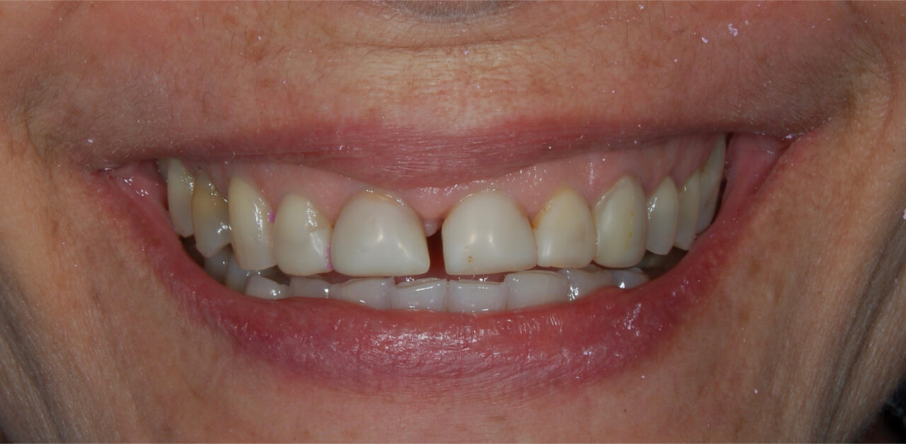 Antes